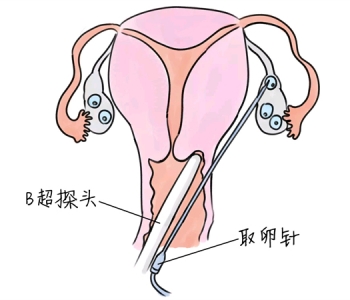小儿退烧推拿手法 5种泉州捐卵宝宝退烧按摩方法